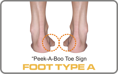 Foot Type A has a valgus forefoot