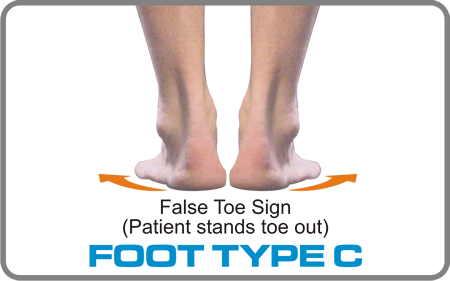 Foot Type C has a neutral forefoot