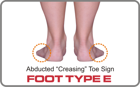 Foot Type E has a varus forefoot