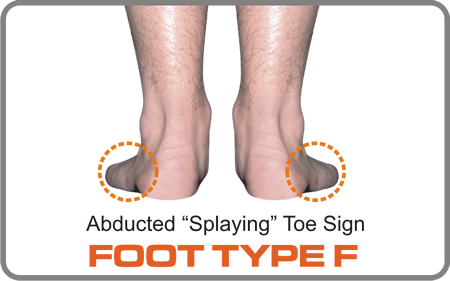Foot Type F has a varus forefoot